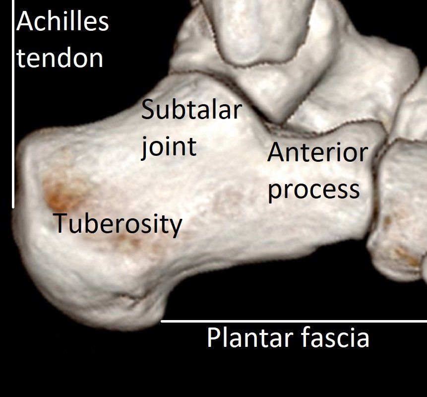 Calcaneus Fractures Dr Ben Beamond Adelaide